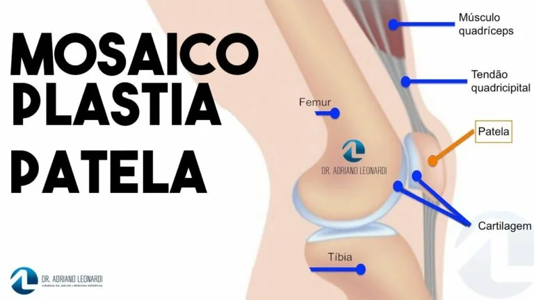 Mosaico plastia da patela.