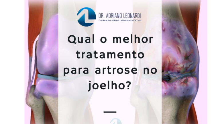 O que é uma infiltração no joelho Especialista do Joelho Dr Adriano Leonardi