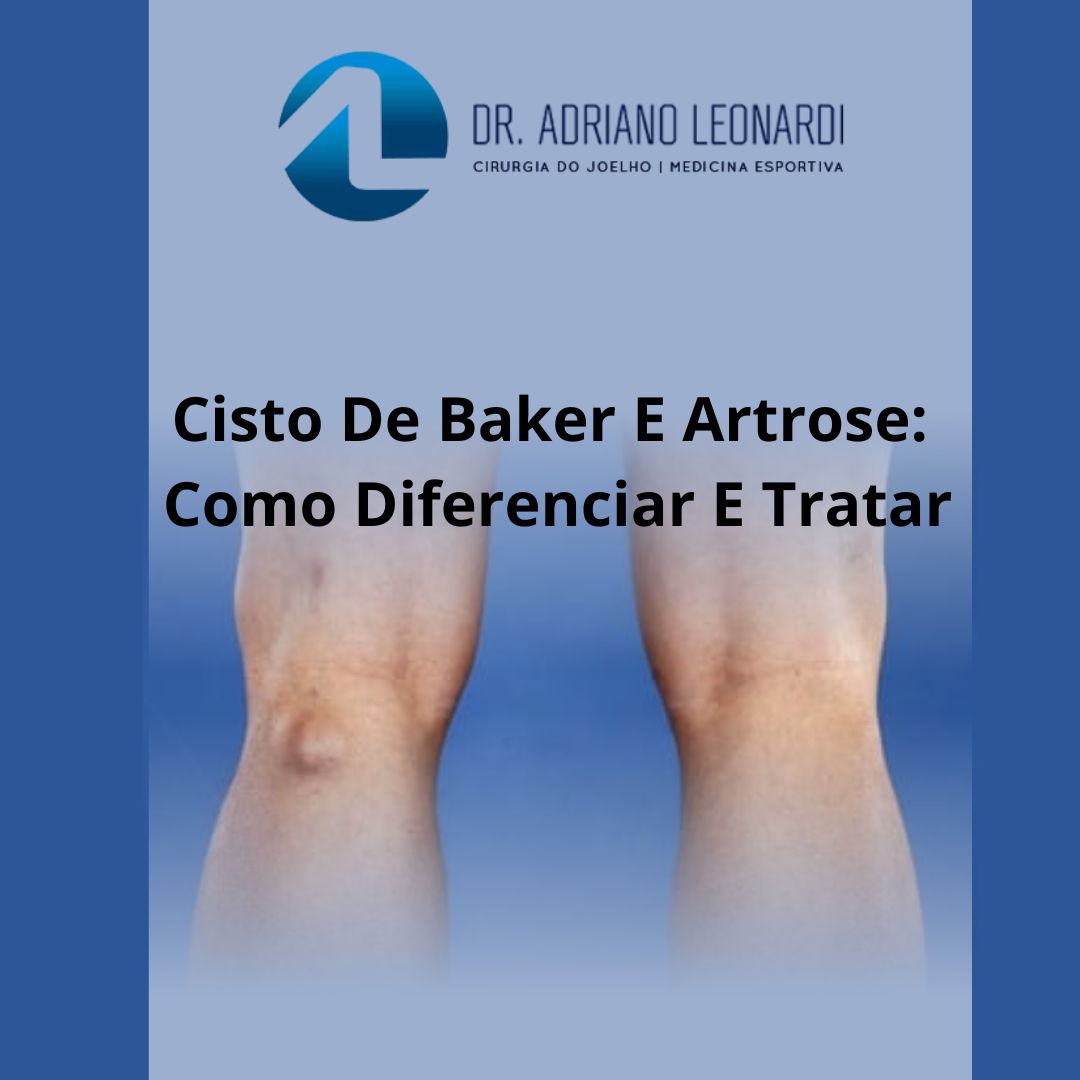 CISTO DE BAKER E ARTROSE: COMO DIFERENCIAR E TRATAR - Especialista do ...