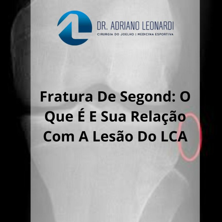 FRATURA DE SEGOND O QUE É E SUA RELAÇÃO COM A LESÃO DO LCA