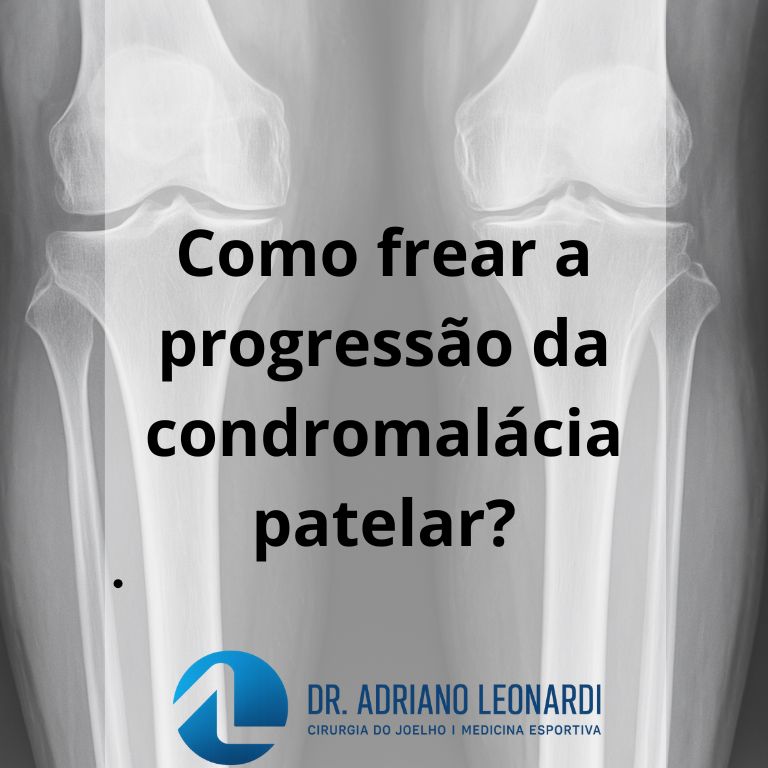 condromalácia patelar