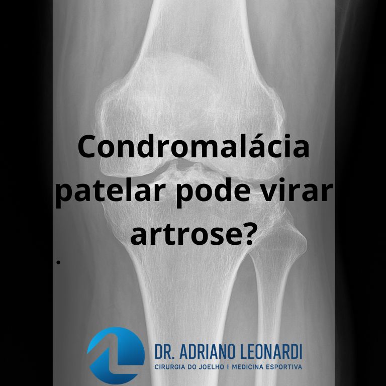 condromalácia patelar