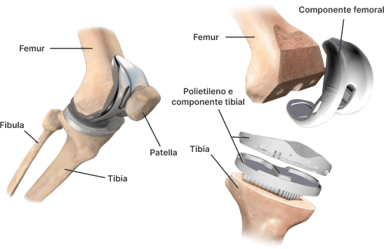 Cirurgia de revisão de prótese de joelho