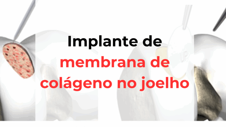Implante de membrana de colágeno no joelho