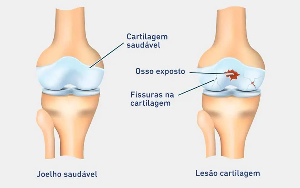 lesão de cacrtilagem condropatia