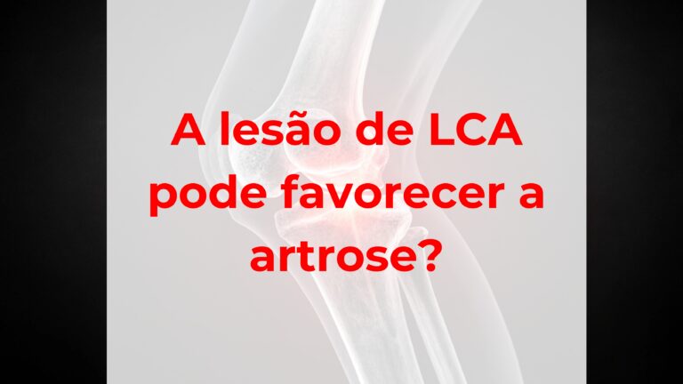 A lesão de LCA pode favorecer a artrose