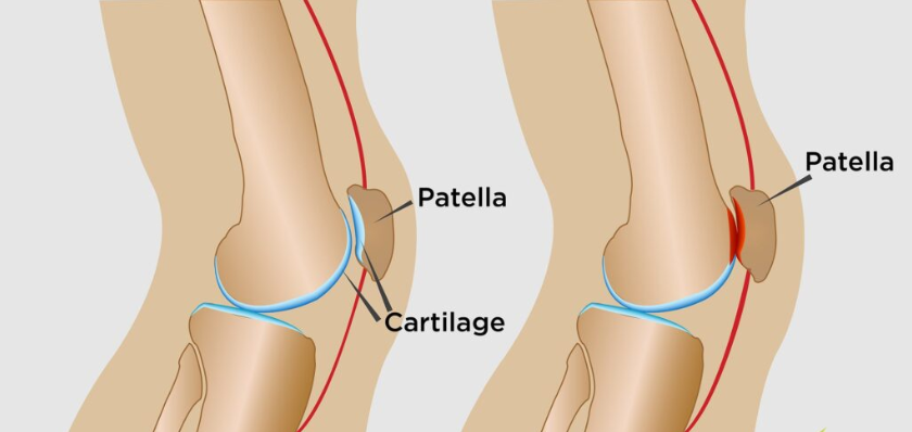Por que mulheres têm mais problemas de joelho?