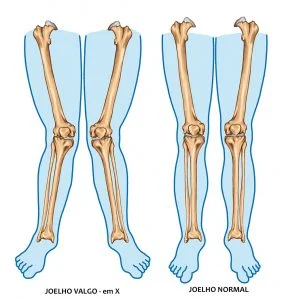Por que mulheres têm mais problemas de joelho?