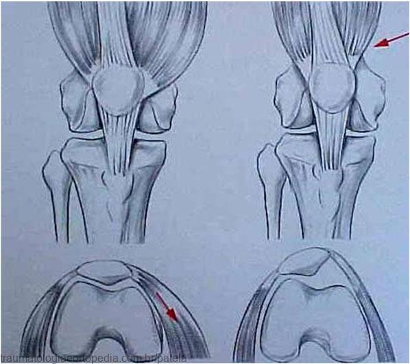 Por que mulheres têm mais problemas de joelho?
