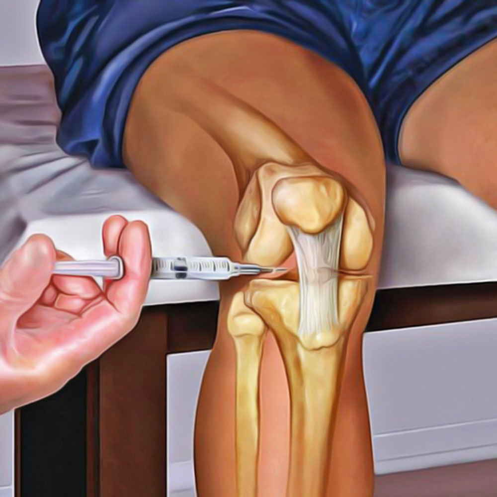 4 atitudes que ajudam a parar a progressão da artrose