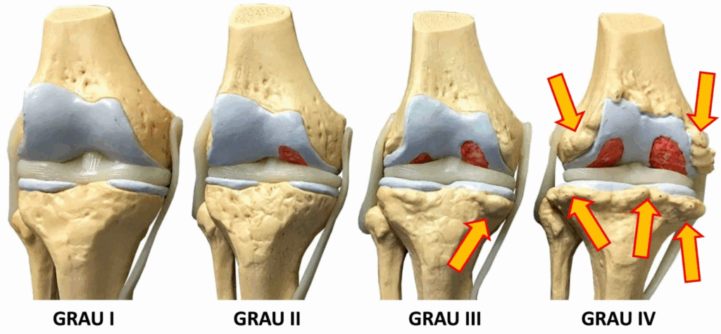 4 atitudes que ajudam a parar a progressão da artrose