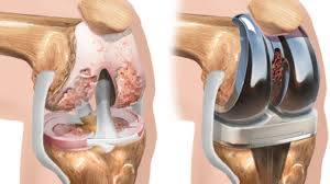 É possível praticar esportes tendo prótese de joelho?