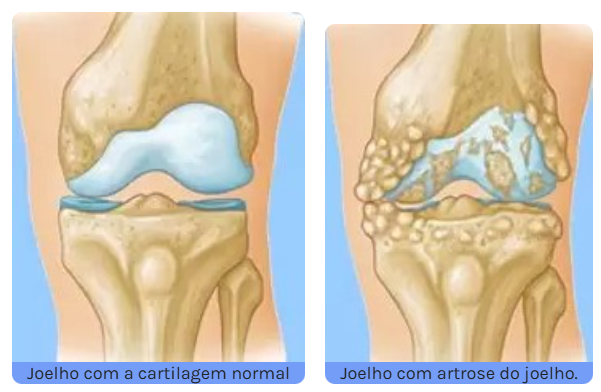 4 sinais que sua artrose está evoluindo muito rápido