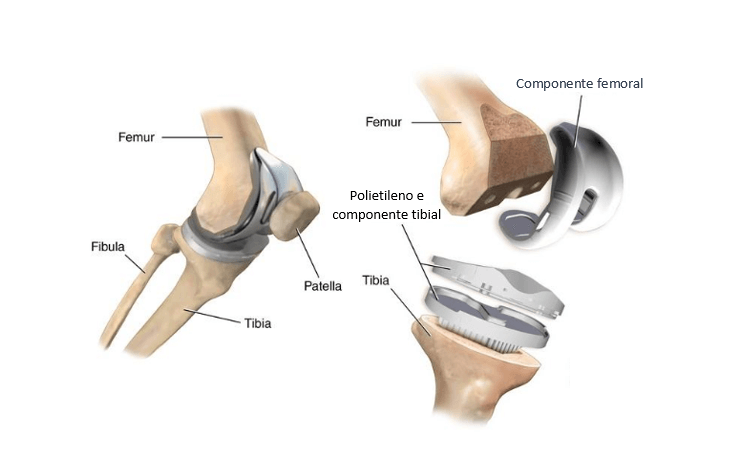 É possível praticar esportes tendo prótese de joelho?