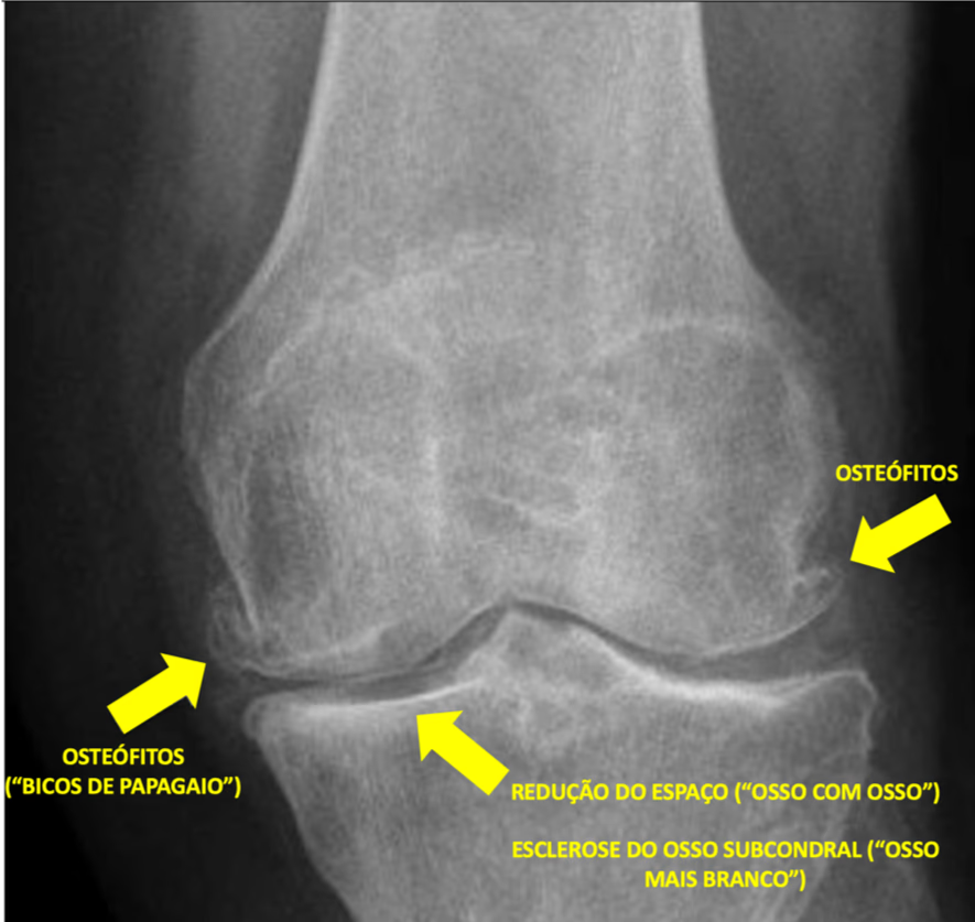 O que é artrose fisiológica?