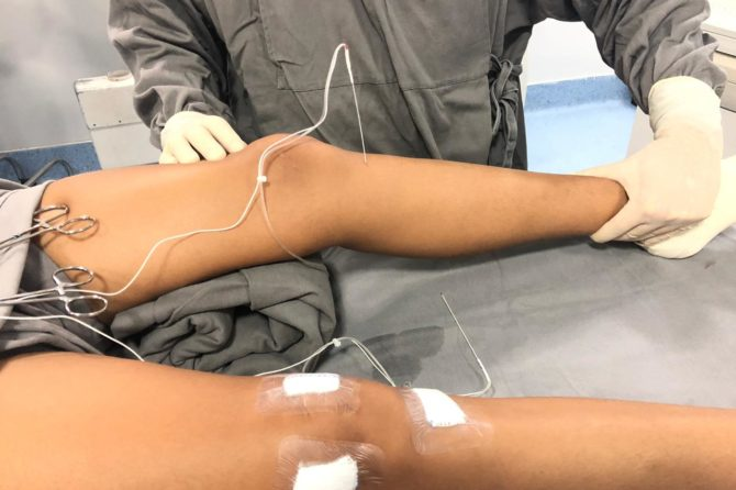 Como evitar a prótese em caso de artrose?