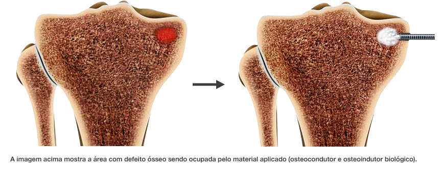 Como evitar a prótese em caso de artrose?