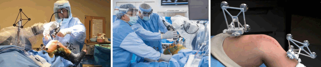 O Robô Faz a Cirurgia Sozinho? Entenda Como Funciona a Cirurgia Robótica de Joelho