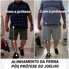 Quais São os Riscos da Cirurgia Robótica de Joelho?