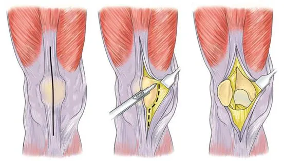 Quais São os Riscos da Cirurgia Robótica de Joelho?