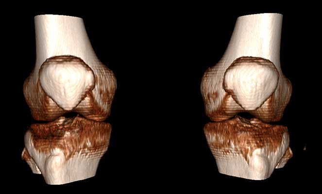 CIRURGIA ROBÓTICA DE JOELHO