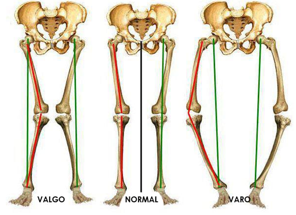 Cirurgia Robótica de Prótese de Joelho é Mais Precisa?