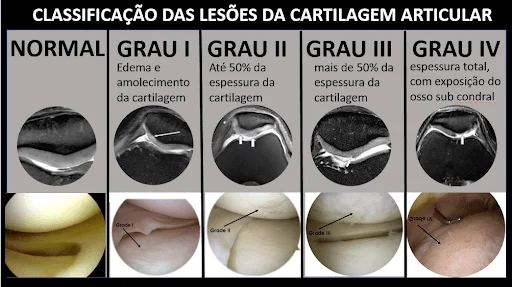 condromalácia patelar