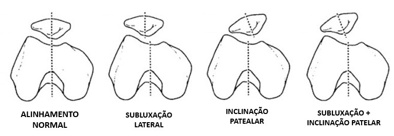 condromalácia patelar