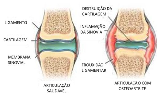 artrose no joelho