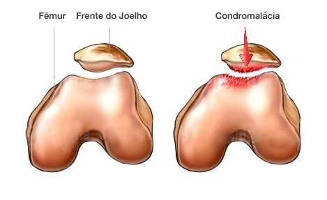 condromalácia patelar