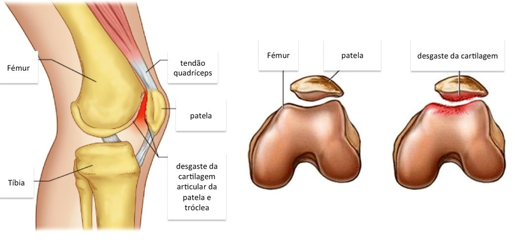 Condromalácia Patelar
